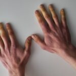 Hand-Arm Vibration Syndrome and What To Know