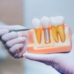 Dental Implants and How They Help